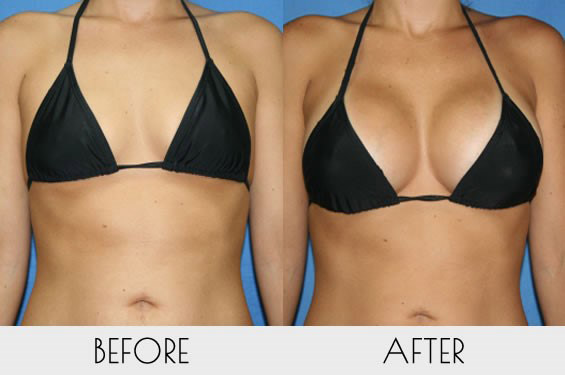 breast augmentation