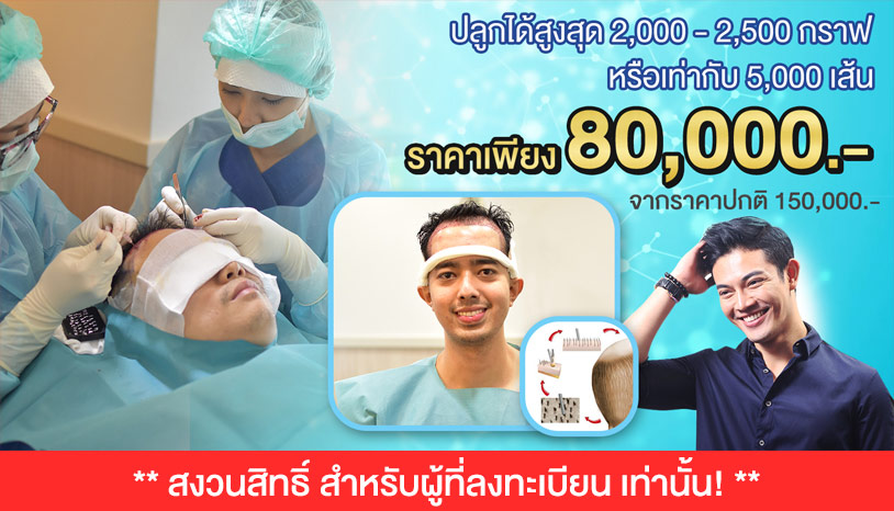  ปลูกผมไร้รอยแผลเย็บ FUE 500-1,000กราฟ เริ่มต้น 50,000 บาท